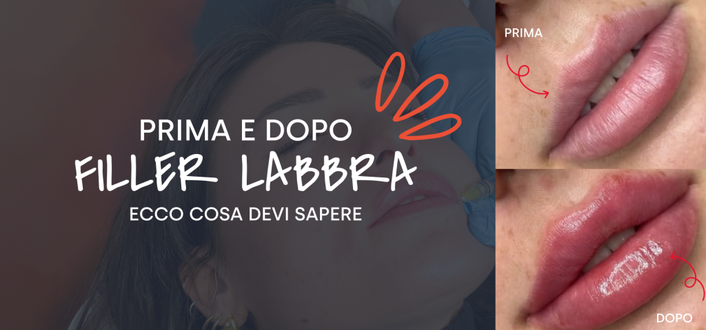 FILLER LABBRA PRIMA E DOPO